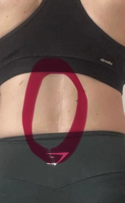 Nicky post surgery. She is now running the Great Welsh Marathon